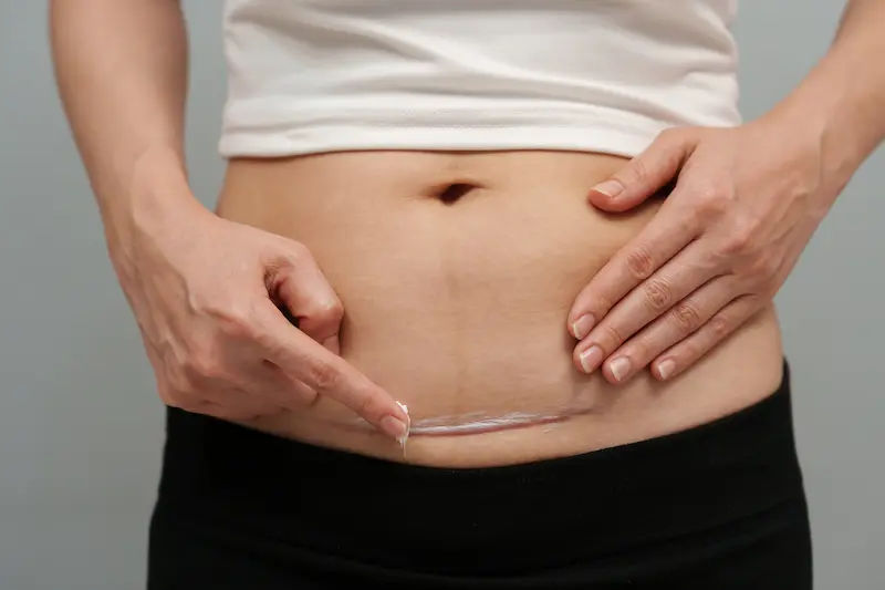 Nicked Bladder During Hysterectomy Surgery